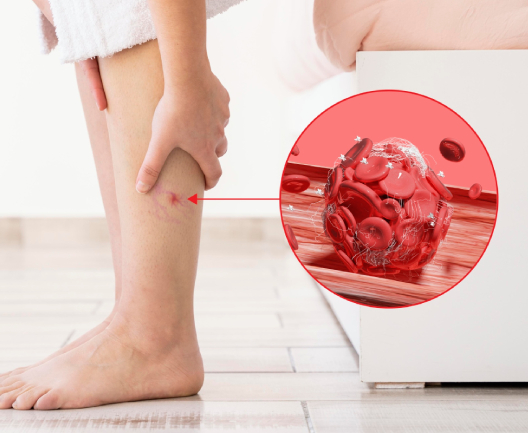 Страх тромбозов: причины, риски и профилактика. Как уберечь себя от тромбов?